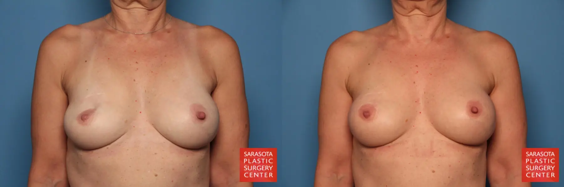 Breast Implant Exchange: Patient 6 - Before and After  