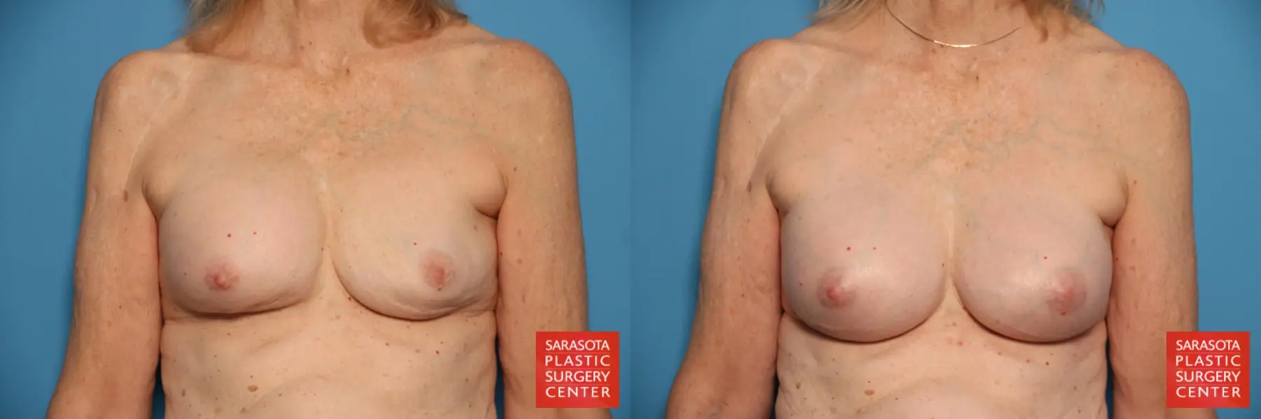 Breast Implant Exchange: Patient 20 - Before and After  