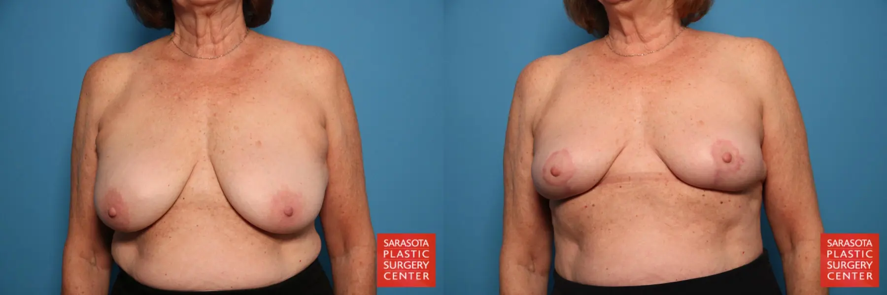 Breast Implant Removal: Patient 4 - Before and After  