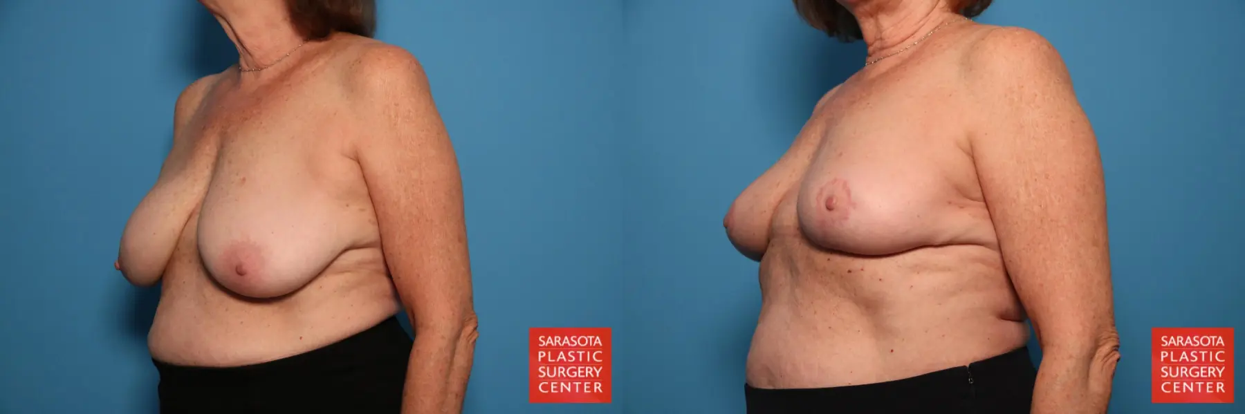 Breast Implant Removal: Patient 4 - Before and After 2