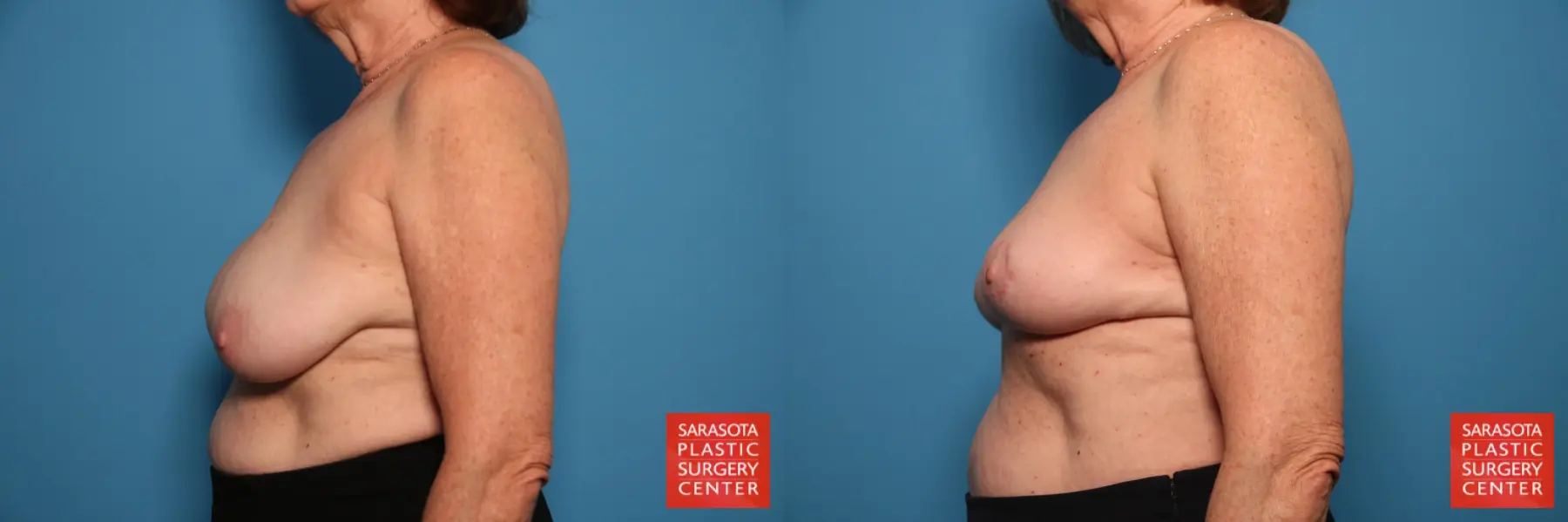 Breast Implant Removal: Patient 4 - Before and After 3