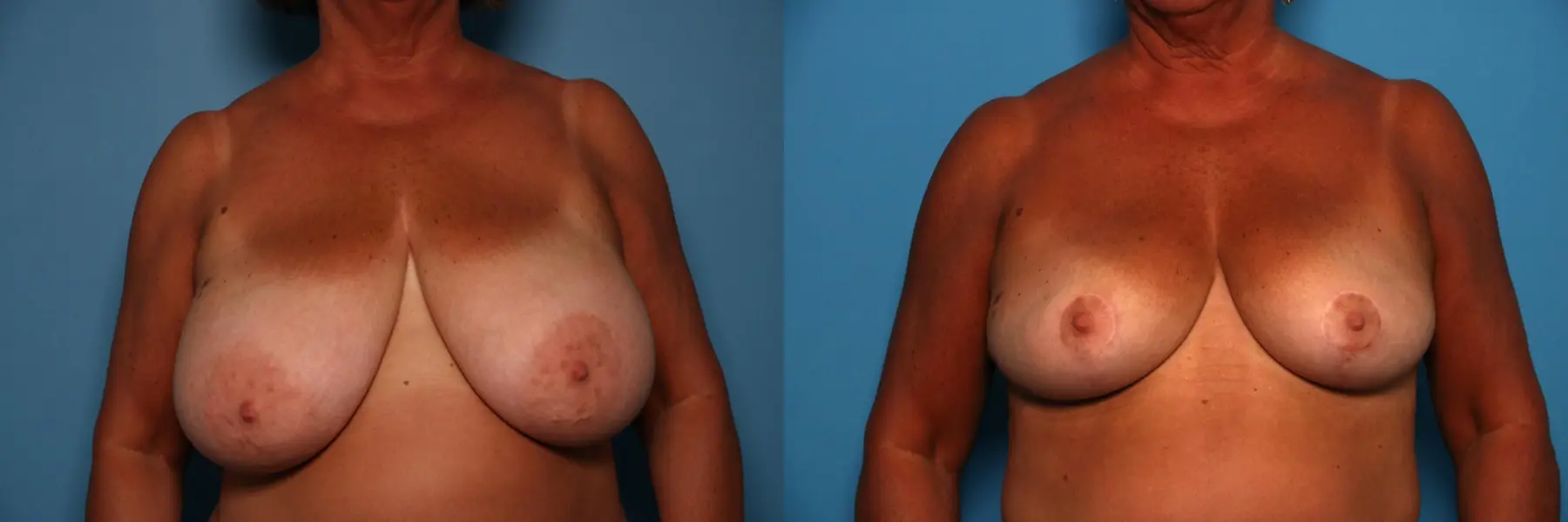 Breast Lift-Reduction: Patient 11 - Before and After  