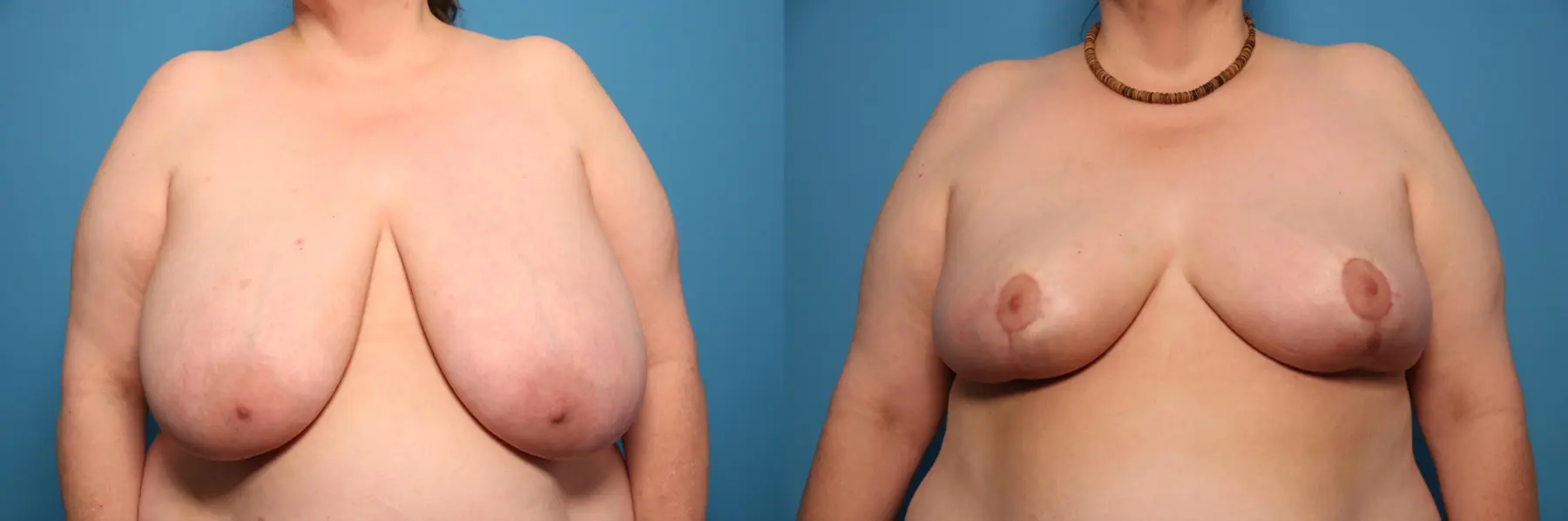 Breast Lift-Reduction: Patient 16 - Before and After  