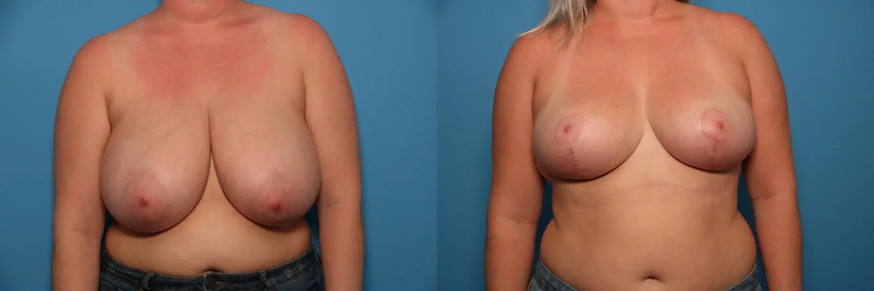 Breast Lift-Reduction: Patient 3 - Before and After  