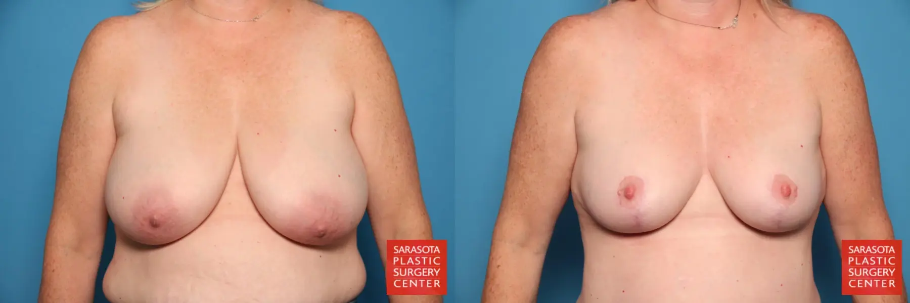 Breast Lift-Reduction: Patient 23 - Before and After  