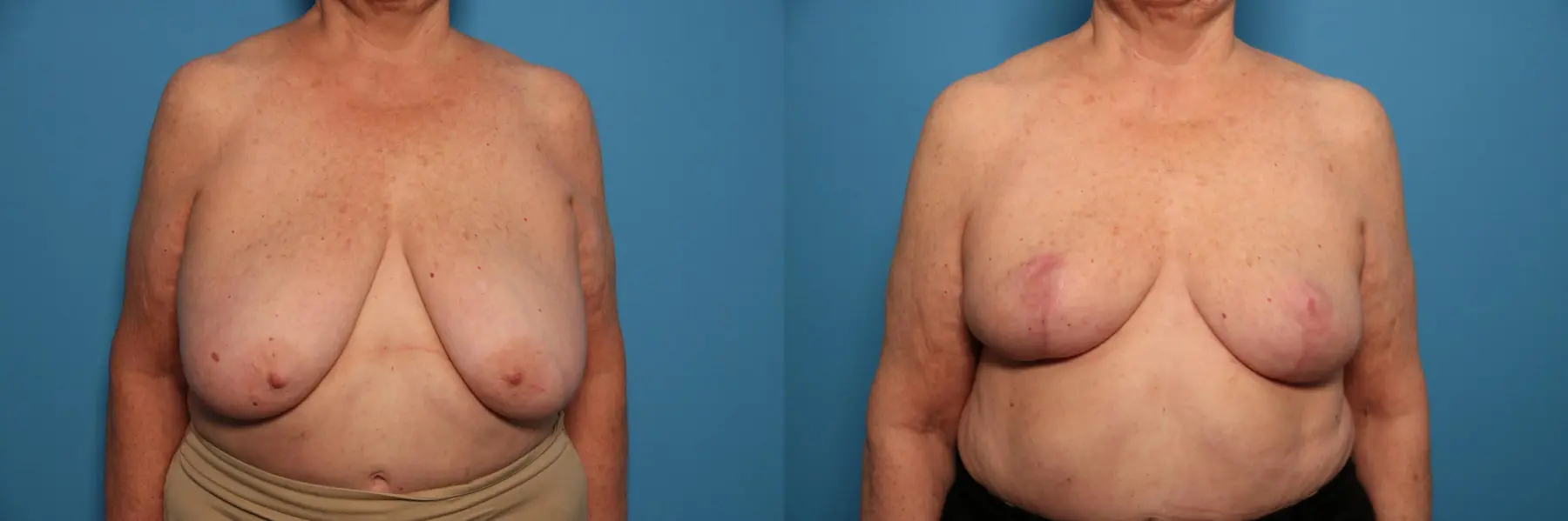 Breast Lift-Reduction: Patient 19 - Before and After  