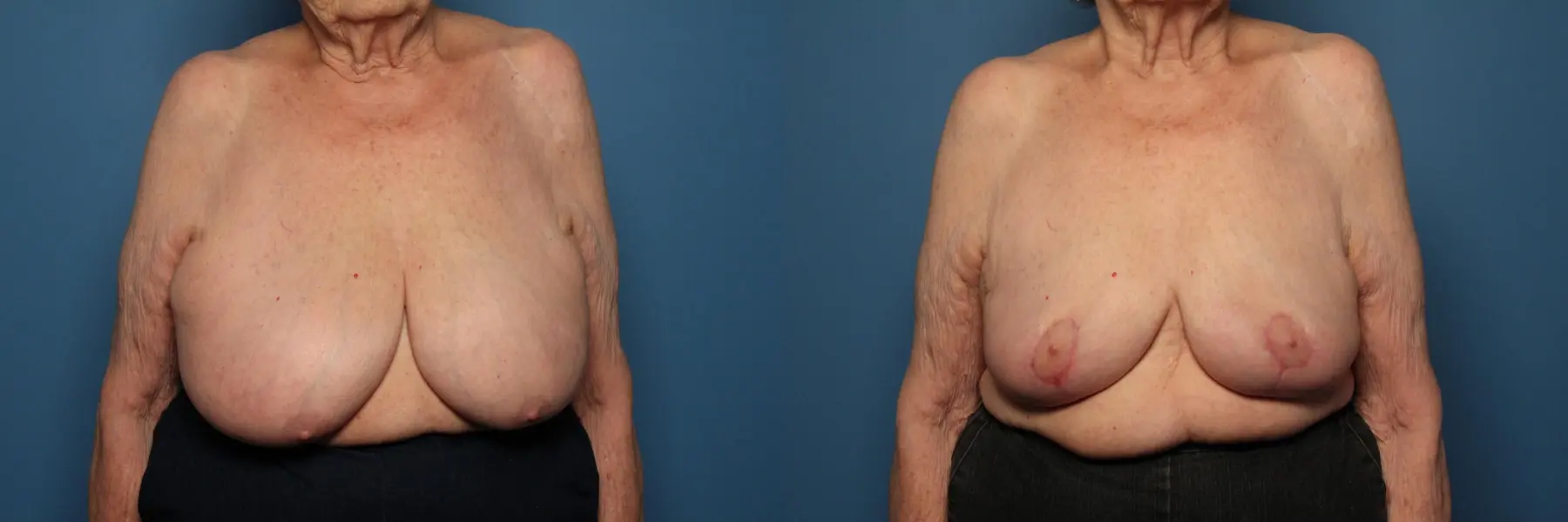 Breast Lift-Reduction: Patient 21 - Before and After  