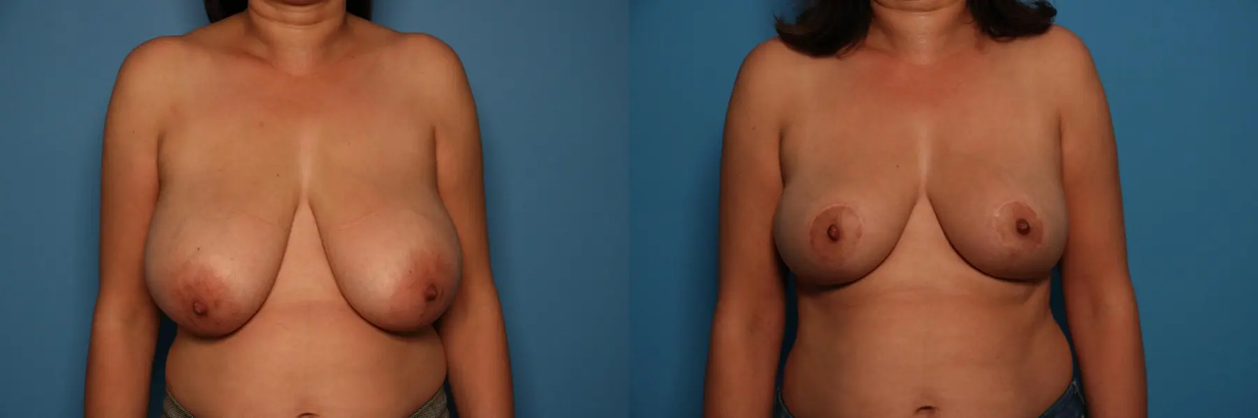 Breast Lift-Reduction: Patient 9 - Before and After  