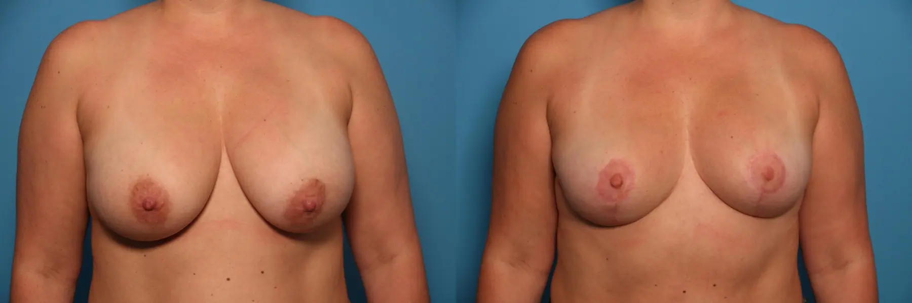 Breast Lift-Reduction: Patient 5 - Before and After  