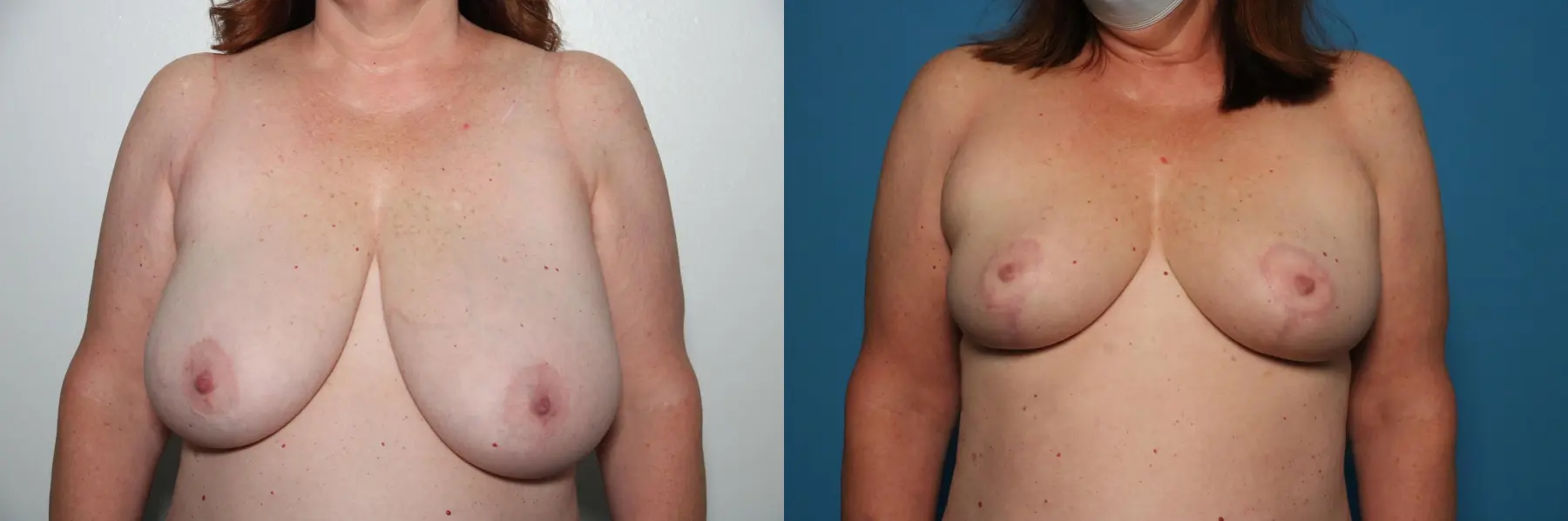 Breast Lift-Reduction: Patient 20 - Before and After  