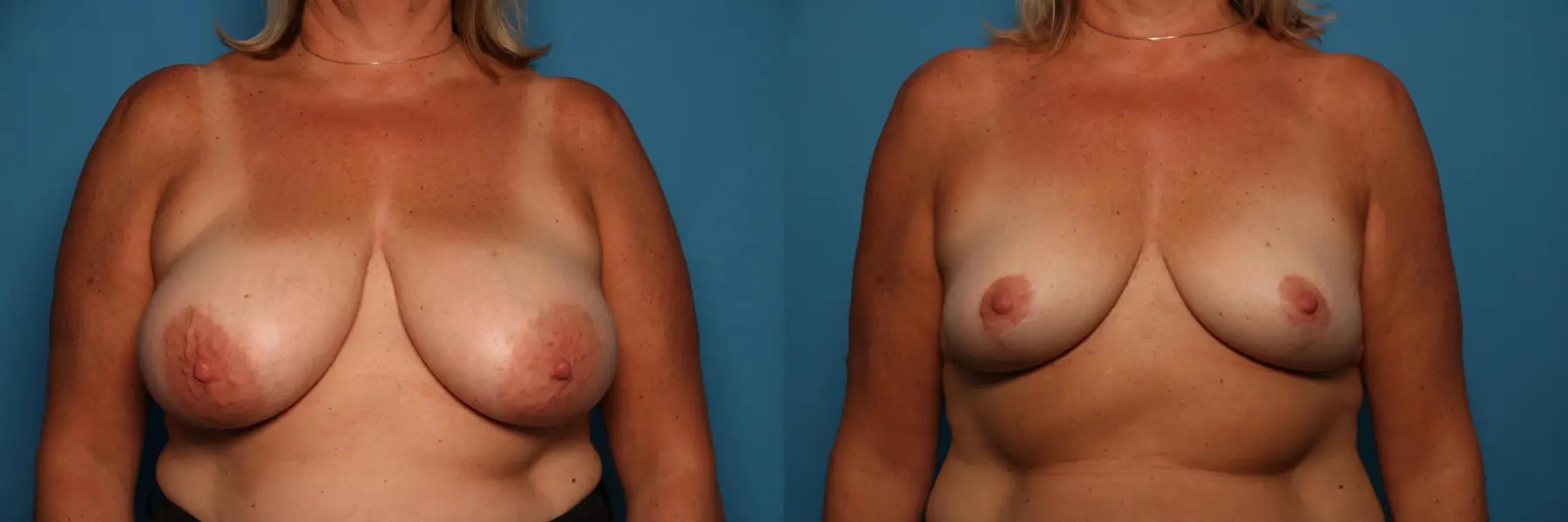 Breast Lift-Reduction: Patient 12 - Before and After  