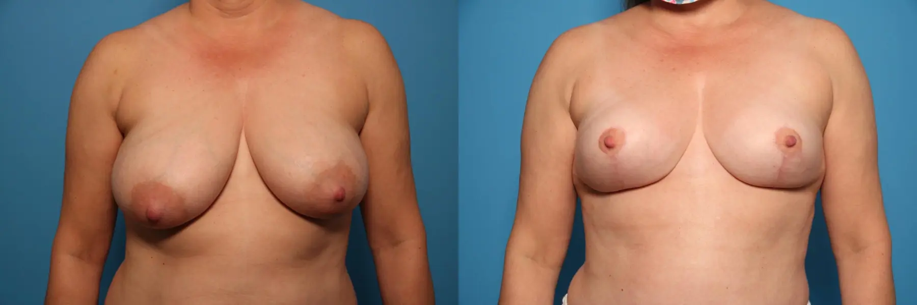 Breast Lift-Reduction: Patient 4 - Before and After  