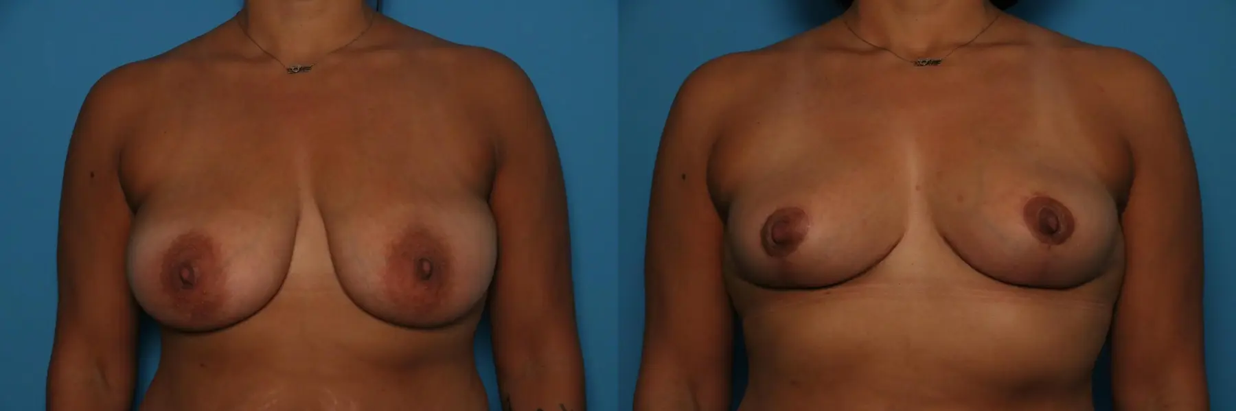 Breast Lift-Reduction: Patient 10 - Before and After  