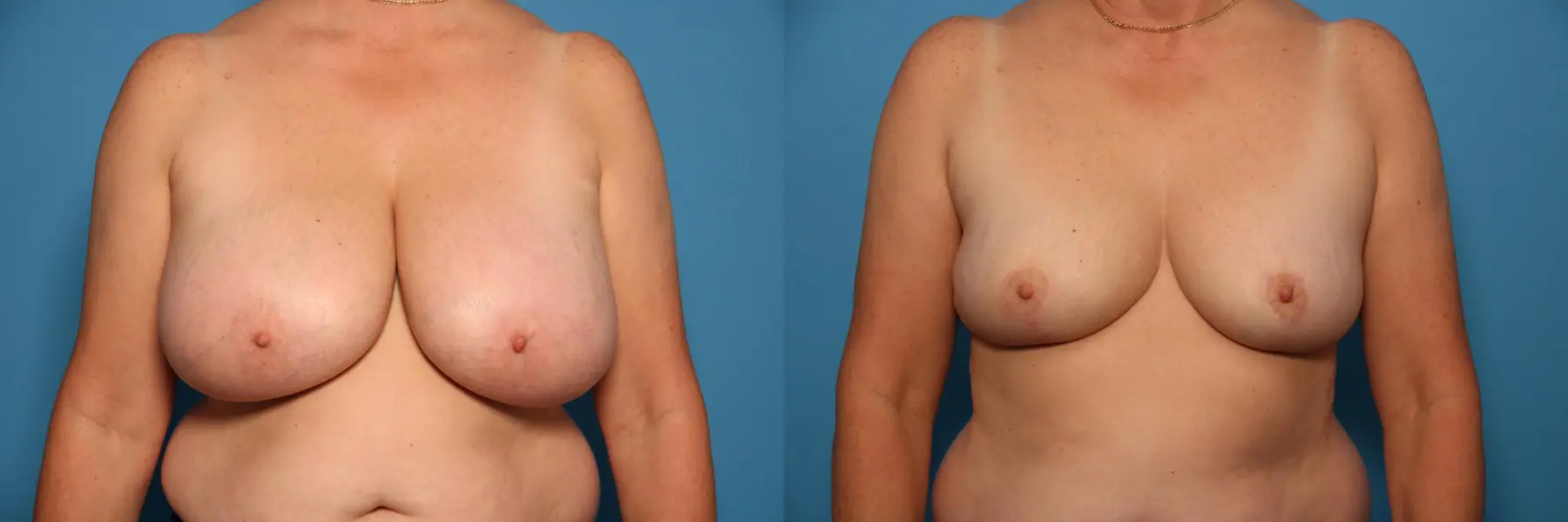 Breast Lift-Reduction: Patient 14 - Before and After  