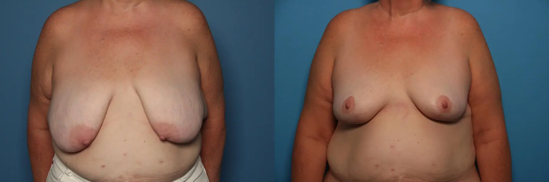 Breast Lift-Reduction: Patient 18 - Before and After  