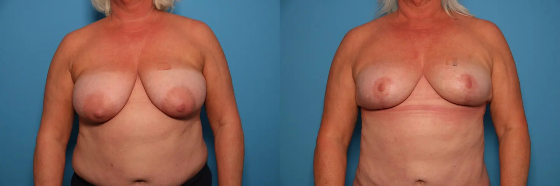 Breast Lift-Reduction: Patient 8 - Before and After  