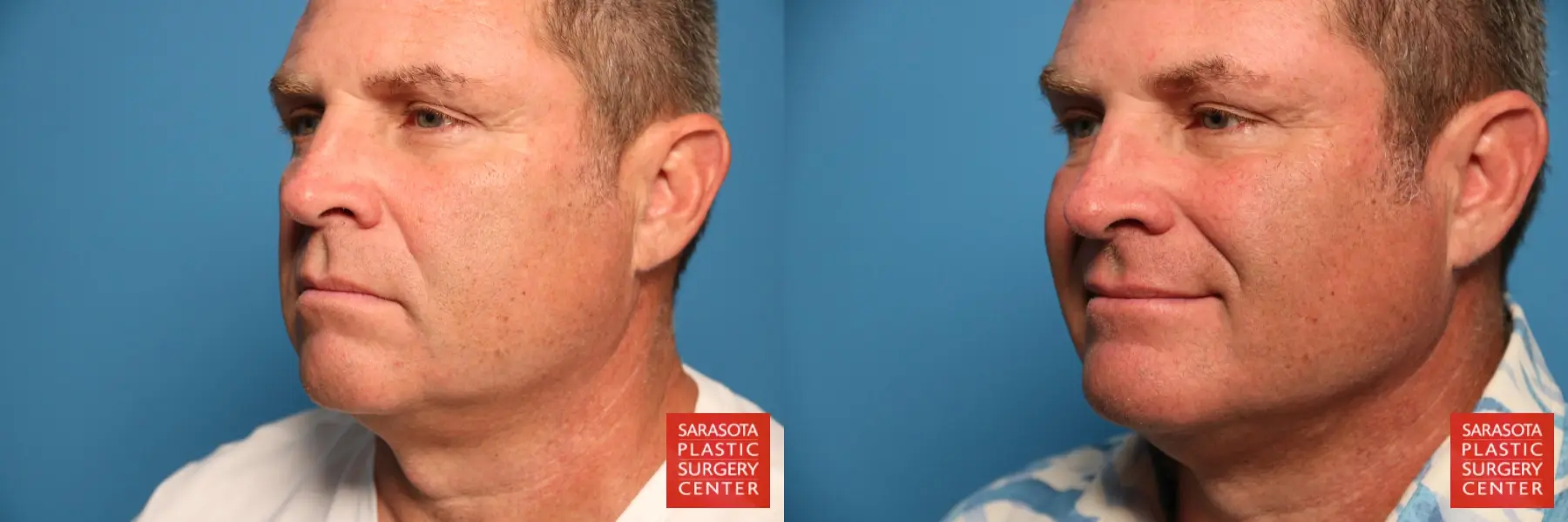 Chin Augmentation: Patient 2 - Before and After  