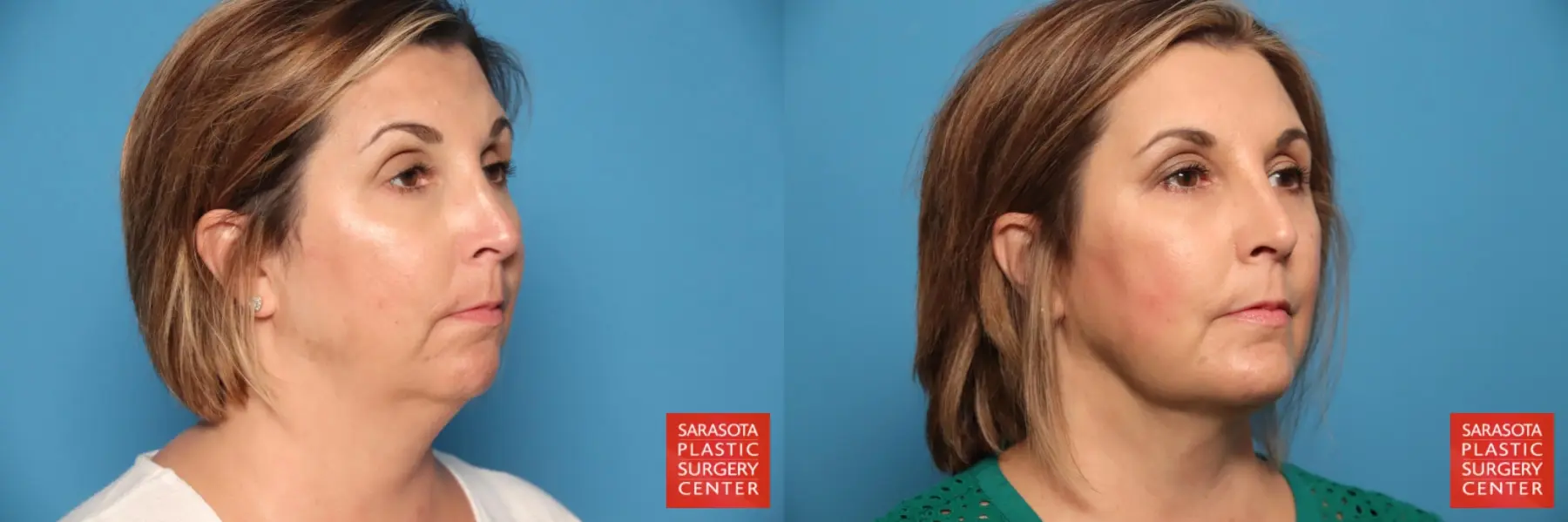 Chin Augmentation: Patient 4 - Before and After 4
