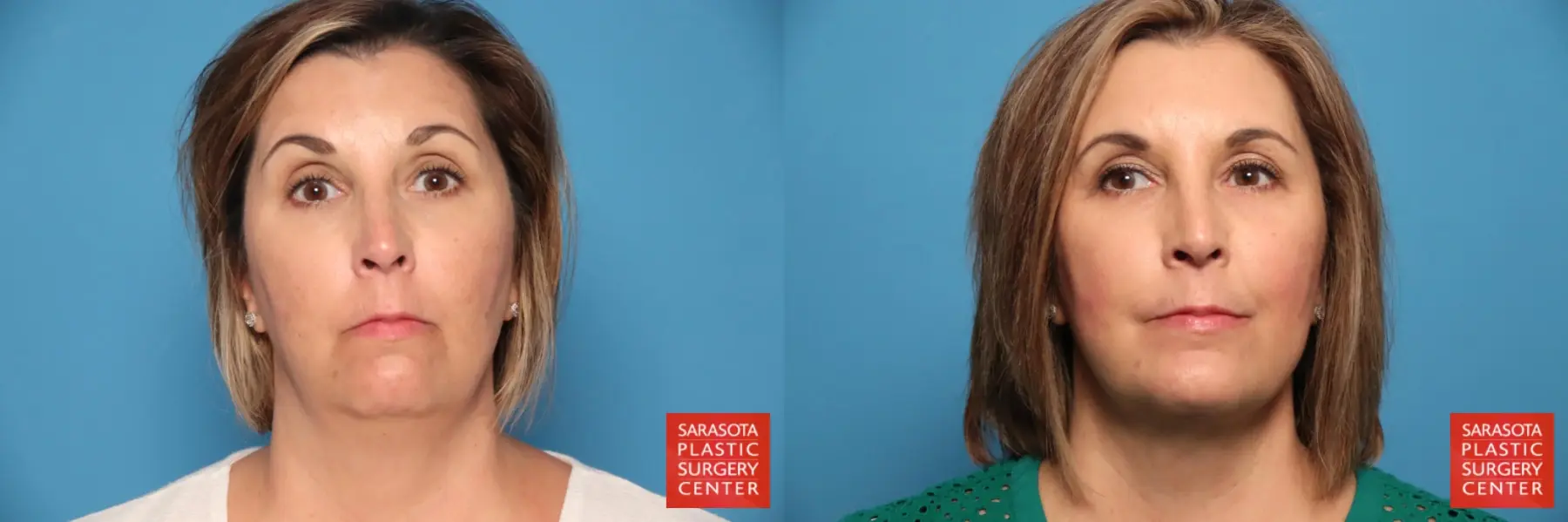 Chin Augmentation: Patient 4 - Before and After  