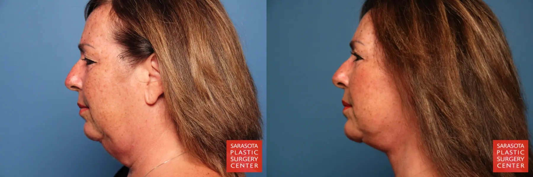 Facelift & Neck Lift: Patient 14 - Before and After  
