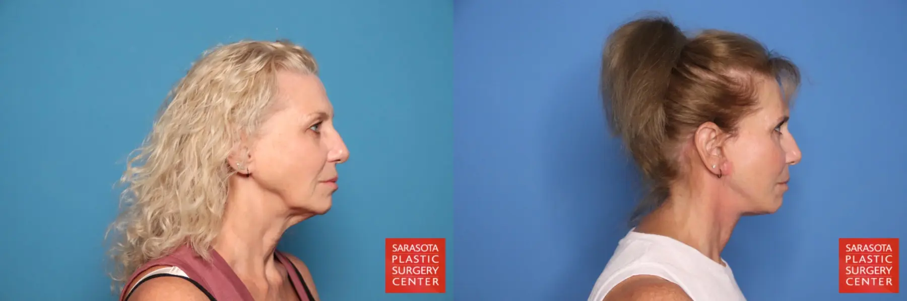 Facelift & Neck Lift: Patient 16 - Before and After 3