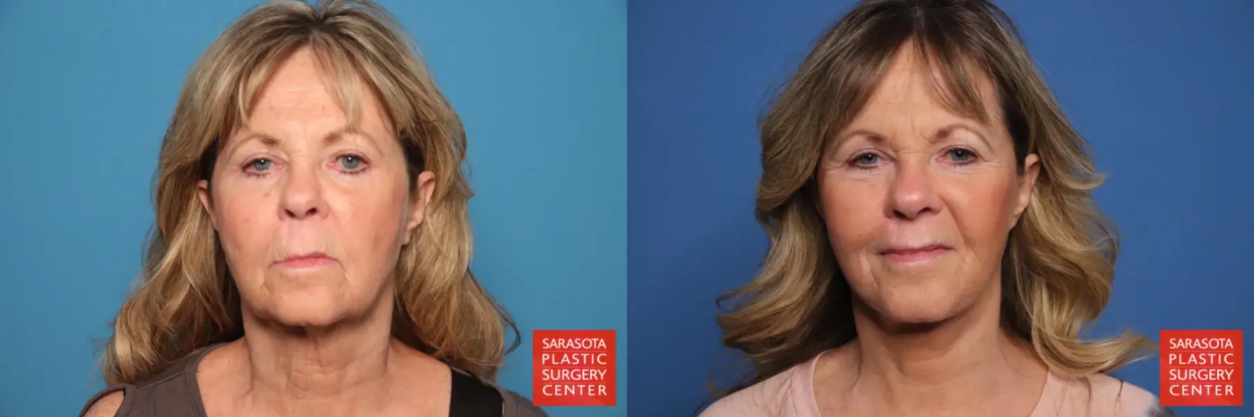 Facelift & Neck Lift: Patient 19 - Before and After  