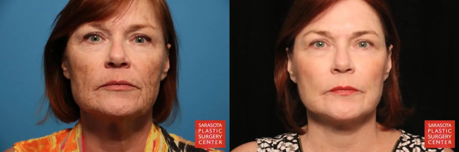 Facelift & Neck Lift: Patient 9 - Before and After  