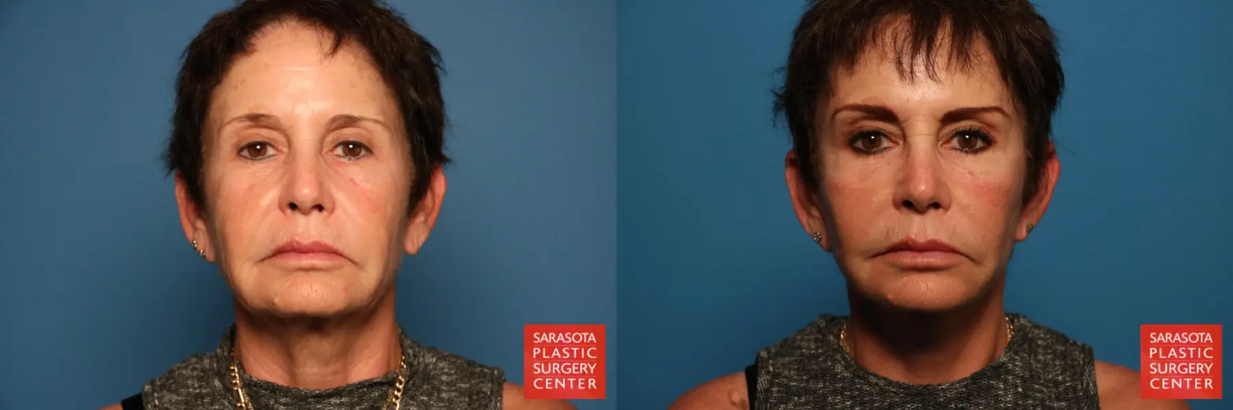 Facelift & Neck Lift: Patient 13 - Before and After  