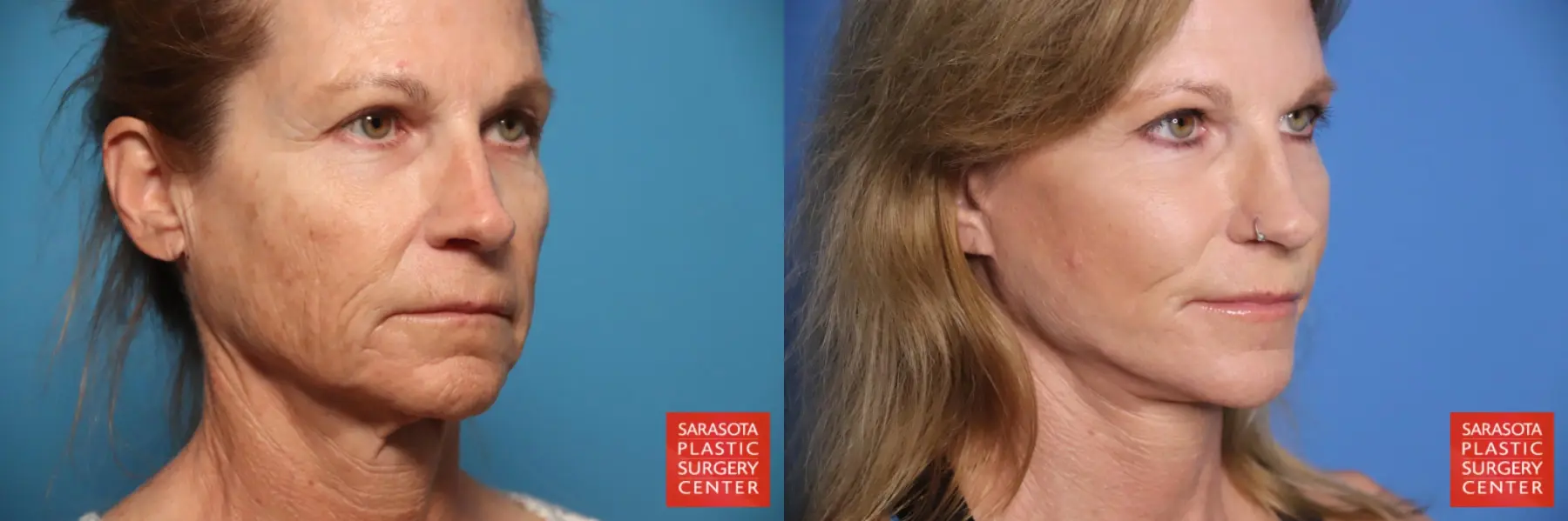 Facelift & Neck Lift: Patient 18 - Before and After 4