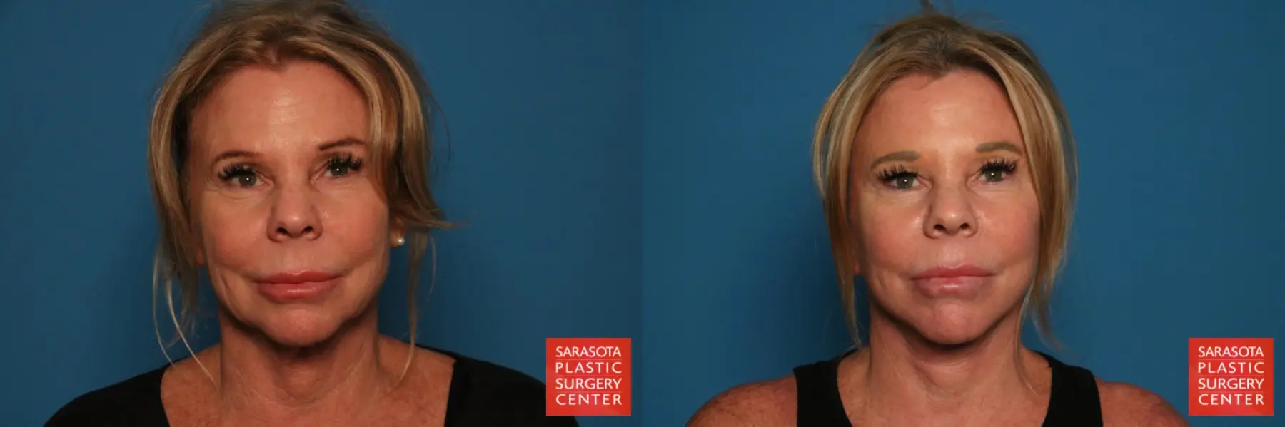 Facelift & Neck Lift: Patient 11 - Before and After  