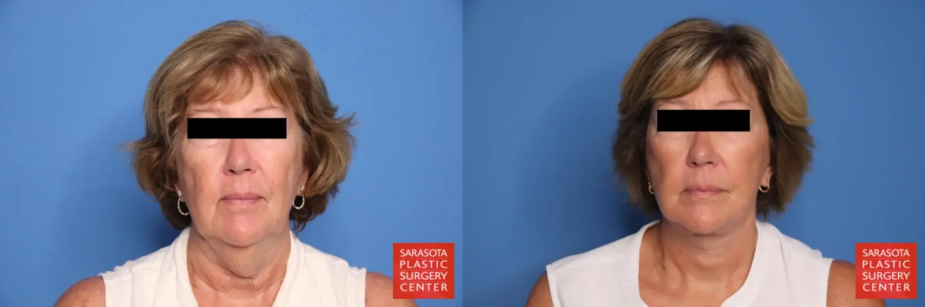 Facelift & Neck Lift: Patient 20 - Before and After  