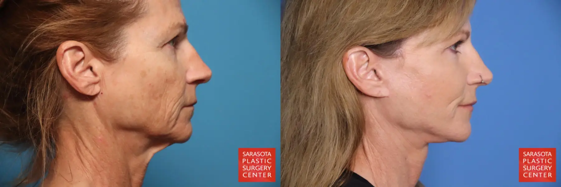 Facelift & Neck Lift: Patient 18 - Before and After 5