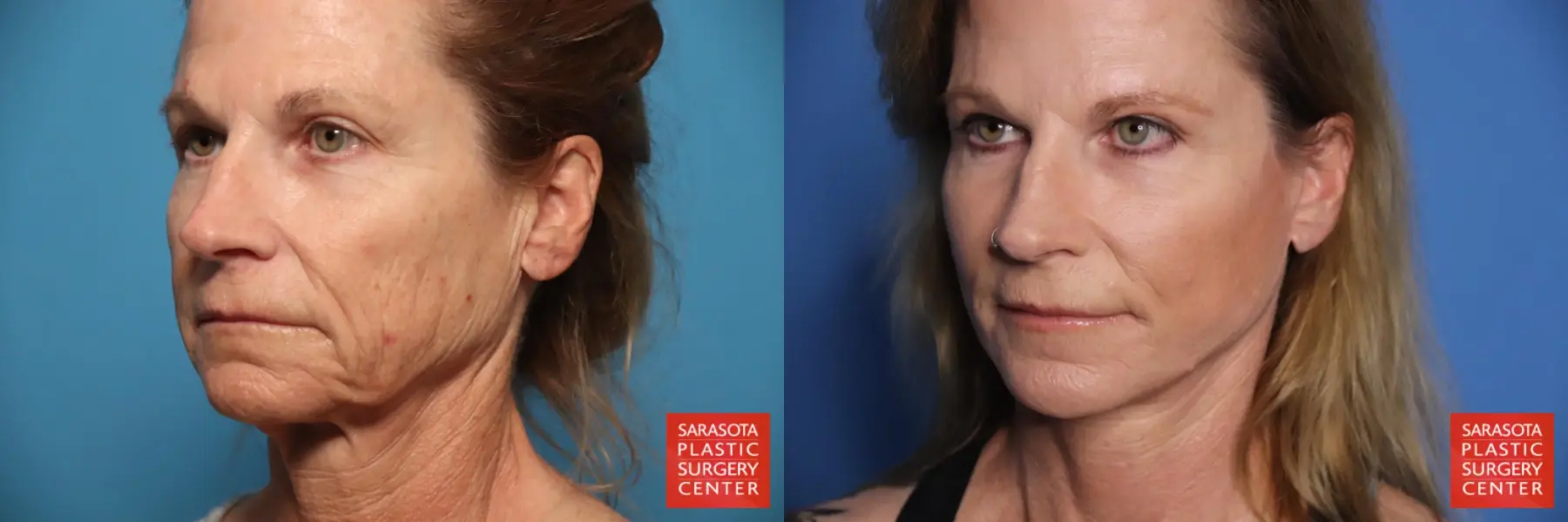 Facelift & Neck Lift: Patient 18 - Before and After 2