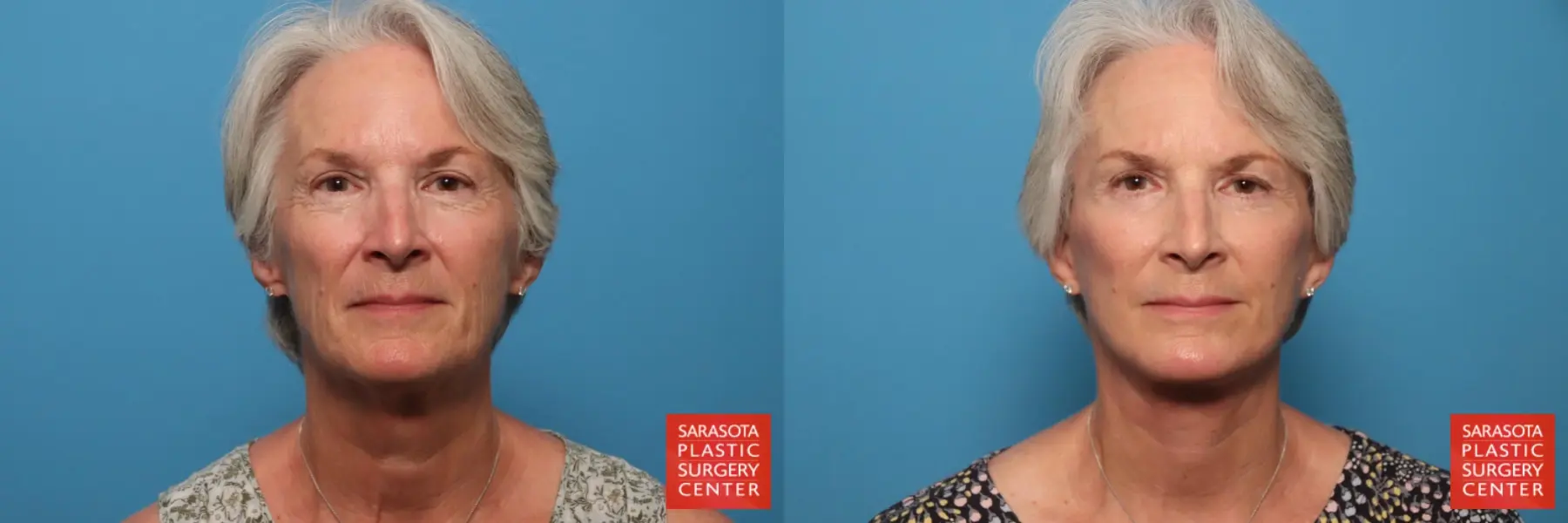 Facelift & Neck Lift: Patient 6 - Before and After  