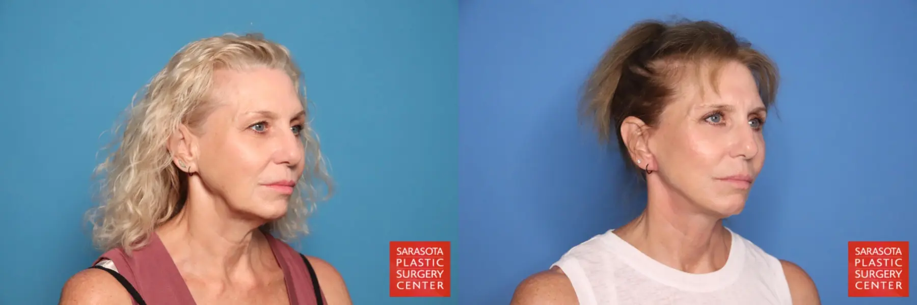 Facelift & Neck Lift: Patient 16 - Before and After 2