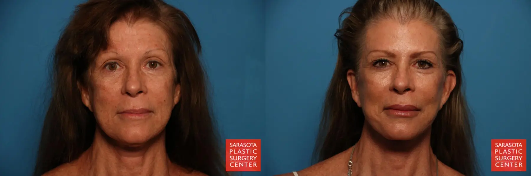 Facelift & Neck Lift: Patient 7 - Before and After  