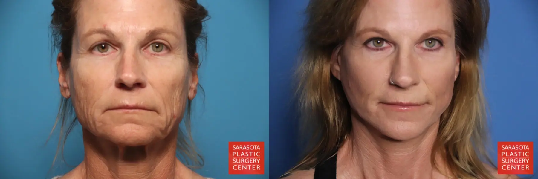Facelift & Neck Lift: Patient 18 - Before and After  