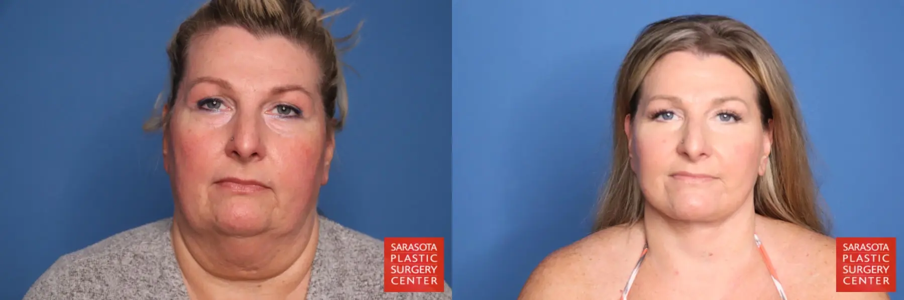 Facelift & Neck Lift: Patient 23 - Before and After  
