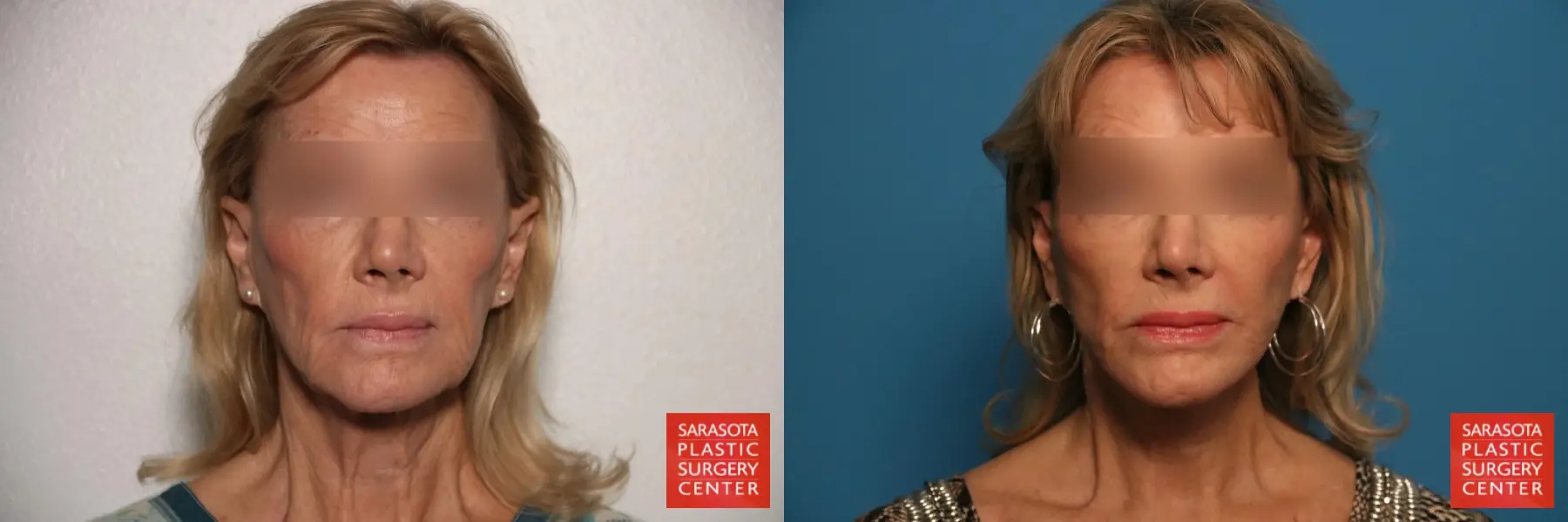 Facelift & Neck Lift: Patient 4 - Before and After  