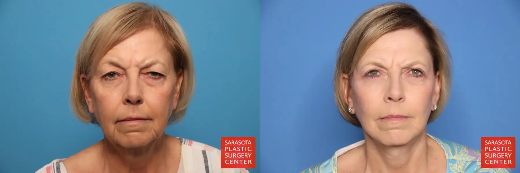 Facelift & Neck Lift: Patient 26 - Before and After  