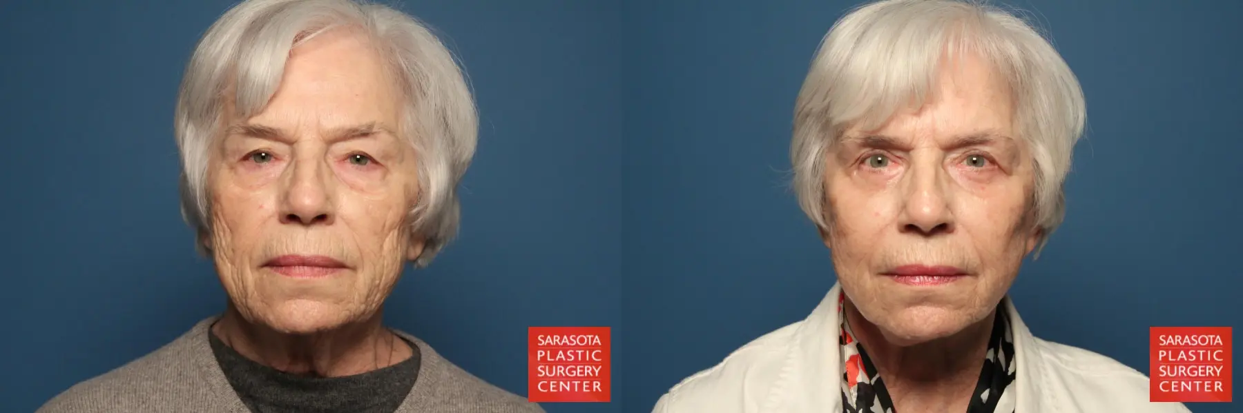 Facelift & Neck Lift: Patient 15 - Before and After  