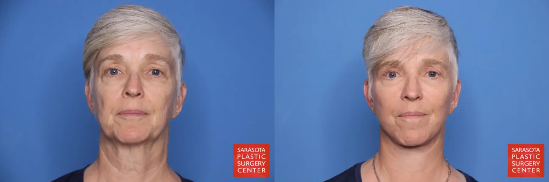 Facelift & Neck Lift: Patient 27 - Before and After  