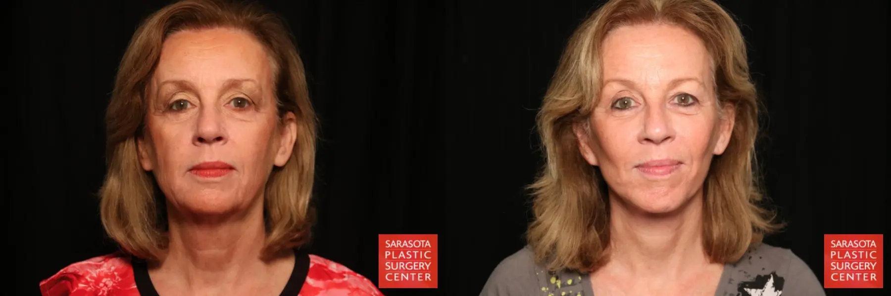 Facelift & Neck Lift: Patient 2 - Before and After  