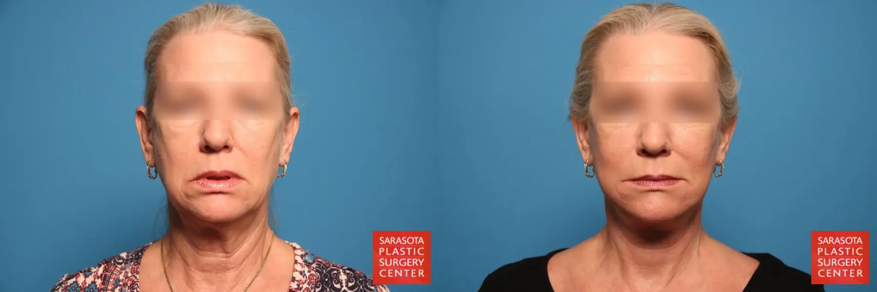 Facelift & Neck Lift: Patient 5 - Before and After  