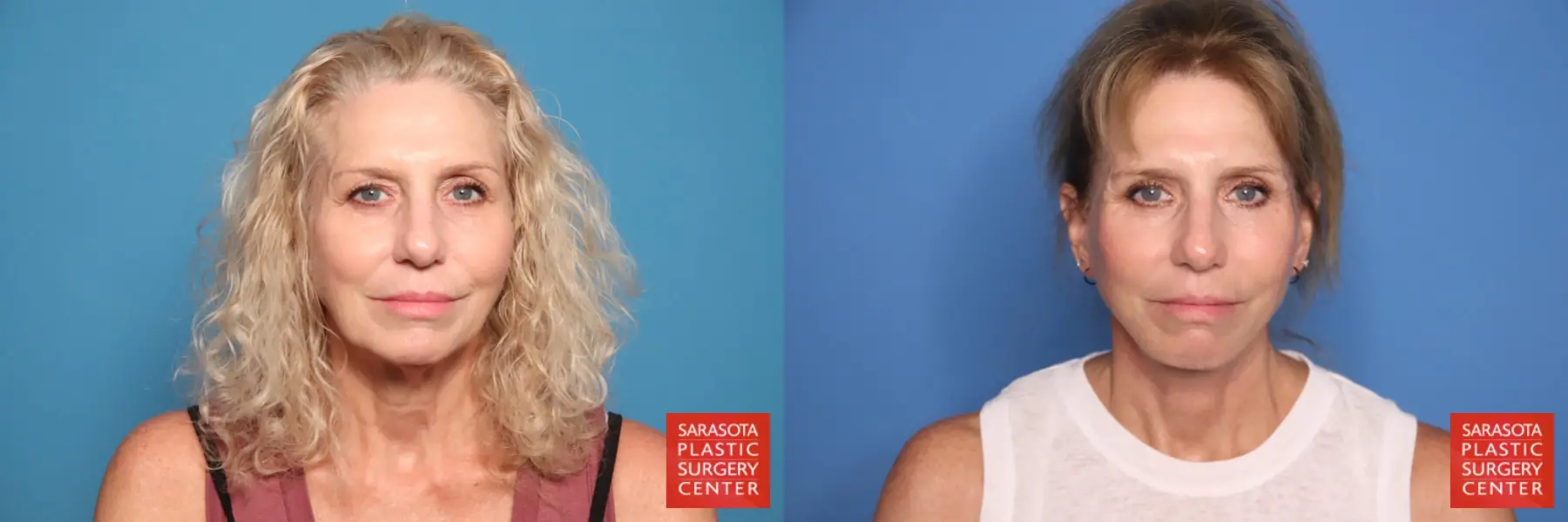 Facelift & Neck Lift: Patient 16 - Before and After  