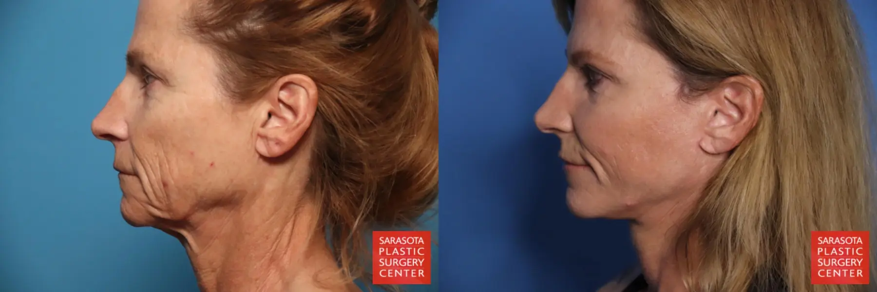 Facelift & Neck Lift: Patient 18 - Before and After 3