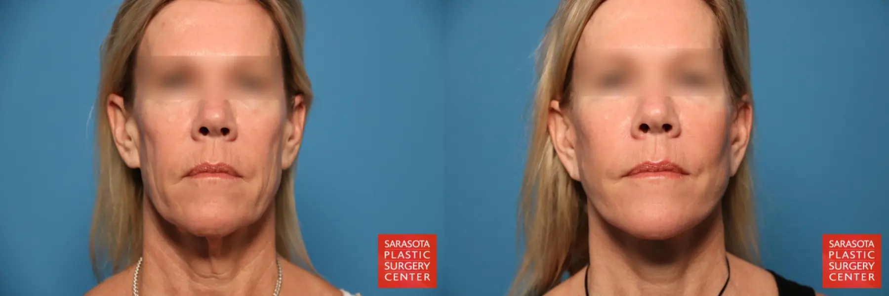 Facelift & Neck Lift: Patient 12 - Before and After  