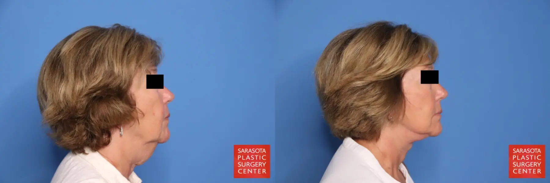 Facelift & Neck Lift: Patient 20 - Before and After 3