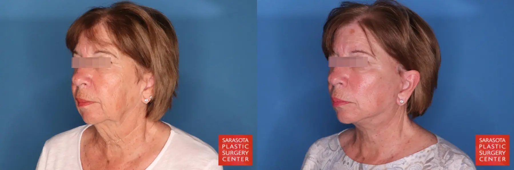 Facelift: Patient 78 - Before and After 2