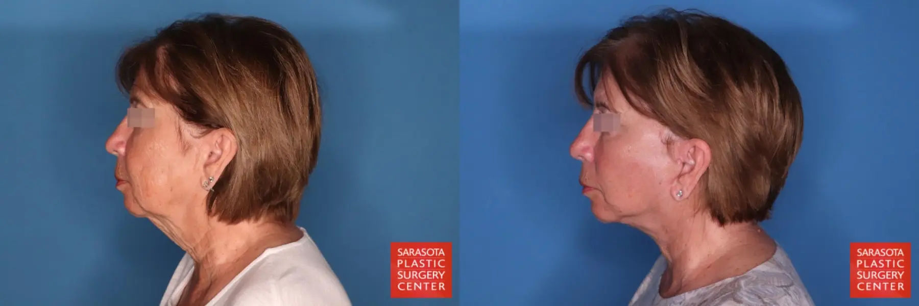 Facelift: Patient 78 - Before and After 3